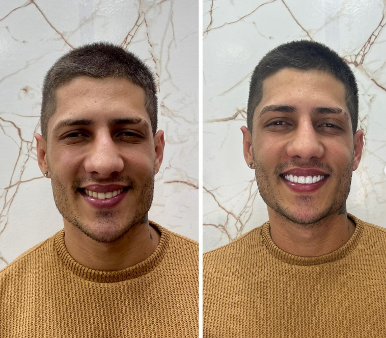 Antes e Depois - Transformação 6